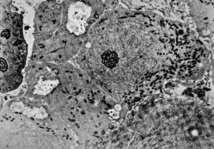 M,12y. | Ewing sarcoma - thorax M,12y. | Ewing sarcoma - thorax